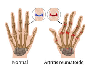 manoartritis